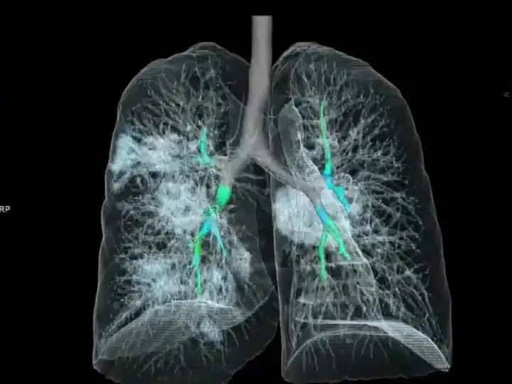 Pneumonia With Covid Can Lead To Death Be Alert