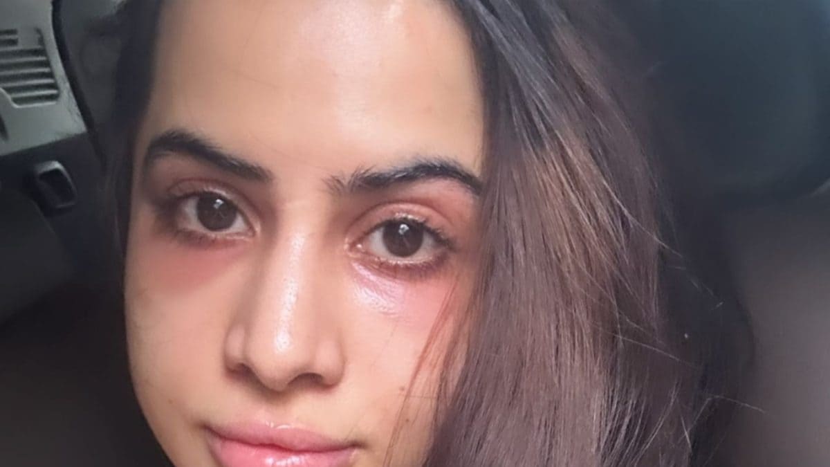 Urfi Javed Shows Disappointing Results Of Getting Under-Eye Fillers After Being Trolled; Photo