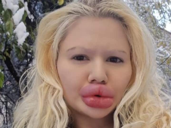 World Biggest Lips Woman Andrea Ivanova Gives Herself Strange Christmas Gift