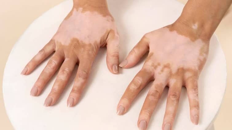 Vitiligo is caused by the lack of a pigment called melanin in the skin चेहरे और शरीर पर सफेद दाग और धब्बे, जानें क्या है विटिलिगो और कैसे होती है ये बीमारी?